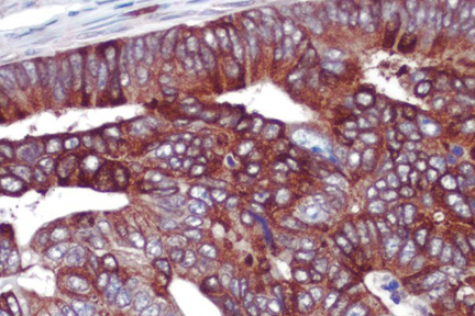 Product - Colon cancer: COX-2 rabbit monoclonal antibody detected with ImmPRESS™ Universal Reagent and Vector® NovaRED® substrate (red). Hematoxylin QS counterstain (blue). Formalin-fixed, paraffin embedded tissue section.