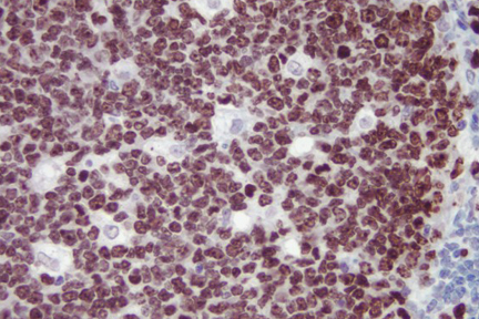 Product - Tonsil: Ki67 antigen detected using ImmPRESS™ Universal Reagent and Vector® NovaRED® (red) substrate. Hematoxylin QS (blue) counterstain.