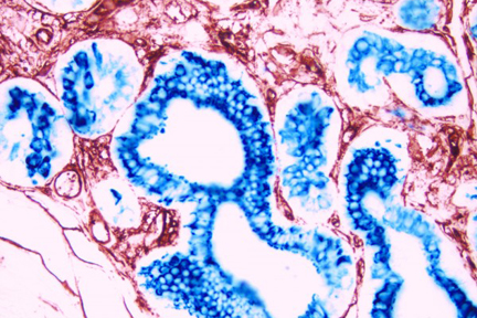 Product - Breast Cancer (double label): Endothelium (red, Vector® NovaRED), epithelium (blue, Vector® Blue).