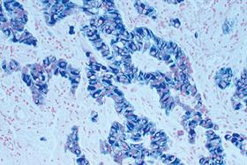 Product - Tumor tissue section showing specific cytoplasmic cell staining (blue/gray, Vector® SG) with Vector® Nuclear Fast Red (red) counterstain.