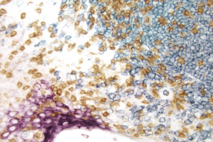 Product - Tonsil (triple label): T cells (brown, Vector® DAB), epithelium (purple, Vector® VIP), B cells (blue/gray, Vector® SG).