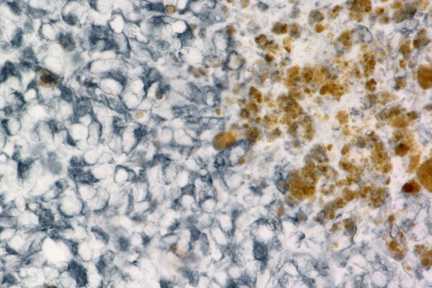 Product - Melanoma was stained with anti-vimentin followed by ImmPRESS™ HRP Anti-Rabbit IgG Reagent and Vector® SG Substrate. Note the excellent contrast of the substrate with the brown pigments.