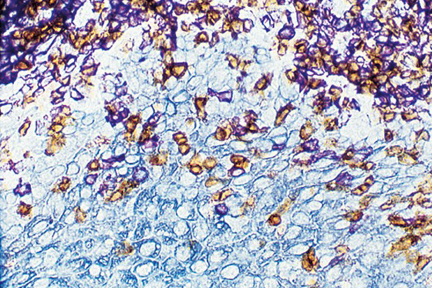 Product - Tonsil triple stained using the VECTASTAIN® Universal Elite® ABC Kit: T cells (brown, DAB), B cells (purple, Vector® VIP), epithelium (blue/gray, Vector® SG).