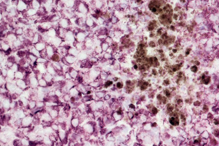Product - Melanoma was stained with anti-vimentin followed by ImmPRESS™ HRP Anti-Rabbit IgG Reagent and Vector® VIP Substrate. Note the excellent contrast of the substrate with the brown pigments.
