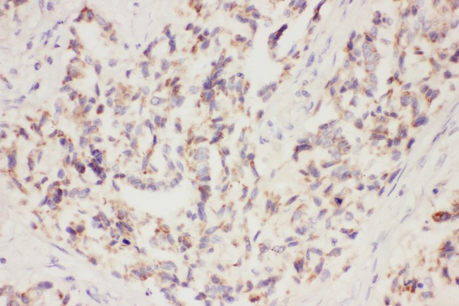 VEGFA / VEGF Antibody - VEGF antibody IHC-paraffin: Human Lung Cancer Tissue.
