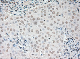 VEGFA / VEGF Antibody - Immunohistochemical staining of paraffin-embedded Adenocarcinoma of breast tissue using anti-VEGF mouse monoclonal antibody. (Dilution 1:50).