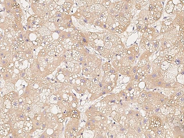 VEGFA / VEGF Antibody - Immunochemical staining of human VEGFA in human hepatoma with mouse monoclonal antibody(1:30, formalin-fixed paraffin embedded sections).