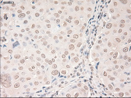 VEGFA / VEGF Antibody - IHC of paraffin-embedded Adenocarcinoma of breast tissue using anti-VEGF mouse monoclonal antibody. (Dilution 1:50).