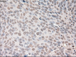 VEGFA / VEGF Antibody - IHC of paraffin-embedded Adenocarcinoma of ovary tissue using anti-VEGF mouse monoclonal antibody. (Dilution 1:50).