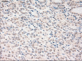 VEGFA / VEGF Antibody - IHC of paraffin-embedded Carcinoma of thyroid tissue using anti-VEGF mouse monoclonal antibody. (Dilution 1:50).