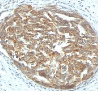 VEGFA / VEGF Antibody - Formalin-fixed, paraffin-embedded human ovarian carcinoma stained with VEGF antibody (SPM225).  This image was taken for the unmodified form of this product. Other forms have not been tested.