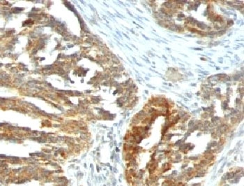 VEGFA / VEGF Antibody - Formalin-fixed, paraffin-embedded human ovarian carcinoma stained with VEGF antibody (VEGF/1063).  This image was taken for the unmodified form of this product. Other forms have not been tested.