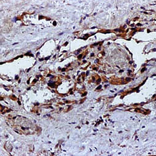 VEGFA / VEGF Antibody - Formalin-fixed, paraffin-embedded human angiosarcoma stained with VEGF antibody.