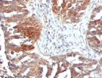 VEGFA / VEGF Antibody - IHC testing of FFPE human ovarian carcinoma with VEGF antibody (clone VGFA-1).  This image was taken for the unmodified form of this product. Other forms have not been tested.