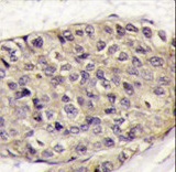 VEGFA / VEGF Antibody - Formalin-fixed and paraffin-embedded human breast carcinoma tissue reacted with VEGF Antibody (C-term)(Cat.#antibody), which was peroxidase-conjugated to the secondary antibody, followed by DAB staining. This data demonstrates the use of this antibody for immunohistochemistry; clinical relevance has not been evaluated.