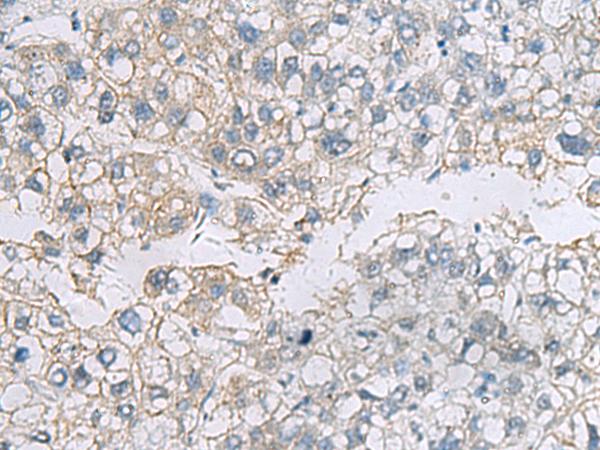 VEGFA / VEGF Antibody - Immunohistochemistry of paraffin-embedded Human liver cancer tissue  using VEGFA Polyclonal Antibody at dilution of 1:45(×200)