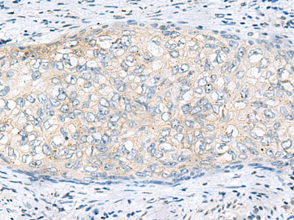 VEGFA / VEGF Antibody - Immunohistochemistry of paraffin-embedded Human cervical cancer tissue  using VEGFA Polyclonal Antibody at dilution of 1:60(×200)