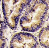 VEGFB Antibody - Formalin-fixed and paraffin-embedded human lung carcinoma tissue reacted with VEGF2 antibody , which was peroxidase-conjugated to the secondary antibody, followed by DAB staining. This data demonstrates the use of this antibody for immunohistochemistry; clinical relevance has not been evaluated.