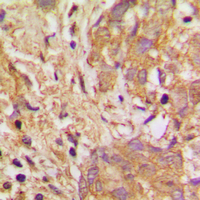 VEGFB Antibody - Immunohistochemical analysis of VEGFB staining in human breast cancer formalin fixed paraffin embedded tissue section. The section was pre-treated using heat mediated antigen retrieval with sodium citrate buffer (pH 6.0). The section was then incubated with the antibody at room temperature and detected using an HRP conjugated compact polymer system. DAB was used as the chromogen. The section was then counterstained with hematoxylin and mounted with DPX.