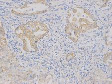 VEGFB Antibody - Immunohistochemistry of paraffin-embedded human endometrial cancer using VEGFB antibody at dilution of 1:200 (200x lens).