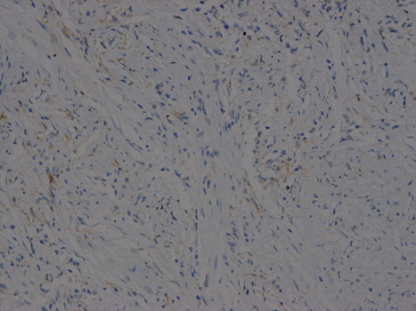 VEGFB Antibody - Immunohistochemistry of paraffin-embedded human stomach cancer using VEGFB antibody at dilution of 1:200 (200x lens).