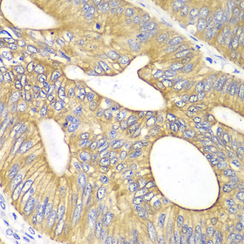 VEGFB Antibody - Immunohistochemistry of paraffin-embedded human colon carcinoma tissue.