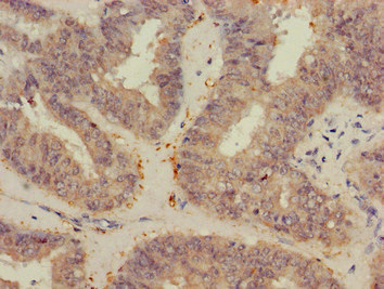 VEGFB Antibody - Immunohistochemistry of paraffin-embedded human endometrial cancer at dilution of 1:100