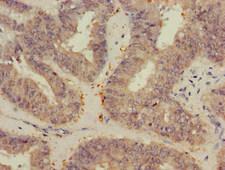 VEGFB Antibody - Immunohistochemistry of paraffin-embedded human endometrial cancer at dilution of 1:100