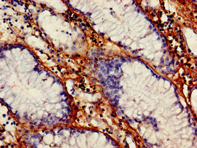 VEGFB Antibody - Immunohistochemistry of paraffin-embedded human gastric cancer at dilution of 1:100