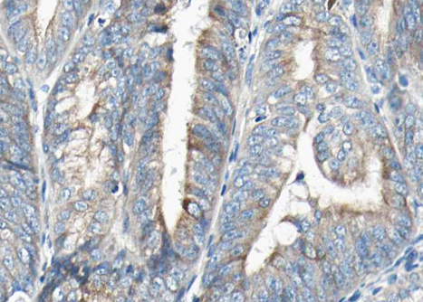 VEGFB Antibody - 1:100 staining human Endometrial carcinoma tissue by IHC-P. The tissue was formaldehyde fixed and a heat mediated antigen retrieval step in citrate buffer was performed. The tissue was then blocked and incubated with the antibody for 1.5 hours at 22°C. An HRP conjugated goat anti-rabbit antibody was used as the secondary.