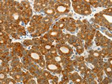 VEGFB Antibody - Immunohistochemistry of paraffin-embedded Human thyroid cancer tissue  using VEGFB Polyclonal Antibody at dilution of 1:25(×200)