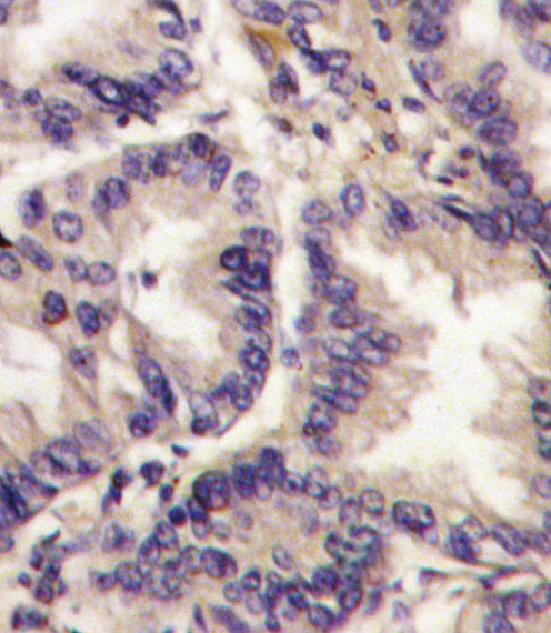 VEGFC Antibody - Formalin-fixed and paraffin-embedded human lung carcinoma tissue reacted with VEGF3 Antibody (Center M263), which was peroxidase-conjugated to the secondary antibody, followed by DAB staining. This data demonstrates the use of this antibody for immunohistochemistry; clinical relevance has not been evaluated.