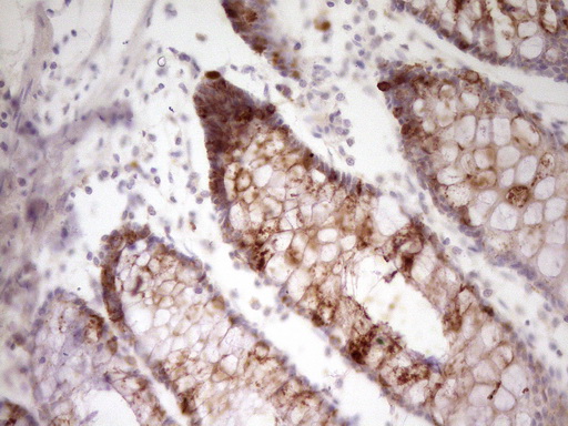 VEGFD Antibody - Immunohistochemical staining of paraffin-embedded Human colon tissue within the normal limits using anti-FIGF mouse monoclonal antibody. (Heat-induced epitope retrieval by 1 mM EDTA in 10mM Tris, pH8.5, 120C for 3min,