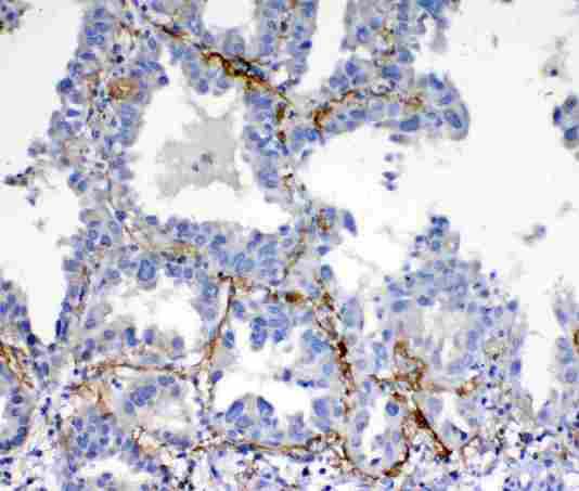 VEGFD Antibody - IHC analysis of VEGFD using anti-VEGFD antibody. VEGFD was detected in paraffin-embedded section of human lung cancer tissue. Heat mediated antigen retrieval was performed in citrate buffer (pH6, epitope retrieval solution) for 20 mins. The tissue section was blocked with 10% goat serum. The tissue section was then incubated with 1µg/ml rabbit anti-VEGFD Antibody overnight at 4°C. Biotinylated goat anti-rabbit IgG was used as secondary antibody and incubated for 30 minutes at 37°C. The tissue section was developed using Strepavidin-Biotin-Complex (SABC) with DAB as the chromogen.