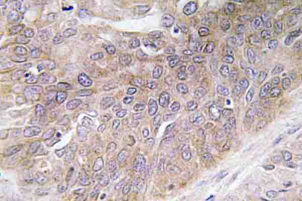 VEGFD Antibody - IHC of VEGF-D (I202) pAb in paraffin-embedded human lung carcinoma tissue.