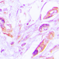 VEGFD Antibody - Immunohistochemical analysis of VEGFD staining in human lung cancer formalin fixed paraffin embedded tissue section. The section was pre-treated using heat mediated antigen retrieval with sodium citrate buffer (pH 6.0). The section was then incubated with the antibody at room temperature and detected using an HRP conjugated compact polymer system. DAB was used as the chromogen. The section was then counterstained with hematoxylin and mounted with DPX.