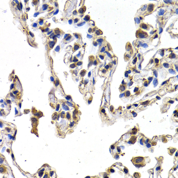 VEGFD Antibody - Immunohistochemistry of paraffin-embedded human lung cancer using VEGFD antibodyat dilution of 1:200 (40x lens).