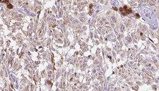 VGF Antibody - 1:100 staining human Melanoma tissue by IHC-P. The sample was formaldehyde fixed and a heat mediated antigen retrieval step in citrate buffer was performed. The sample was then blocked and incubated with the antibody for 1.5 hours at 22°C. An HRP conjugated goat anti-rabbit antibody was used as the secondary.