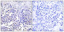 VGF Antibody - Peptide - + Immunohistochemistry analysis of paraffin-embedded human lung carcinoma tissue using VGF antibody.