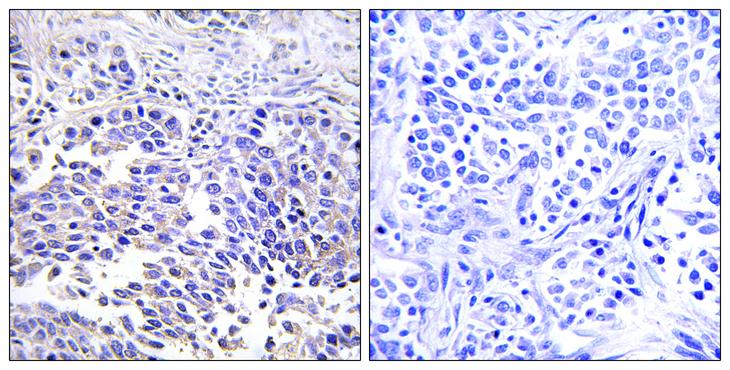 VGF Antibody - Peptide - + Immunohistochemistry analysis of paraffin-embedded human lung carcinoma tissue using VGF antibody.