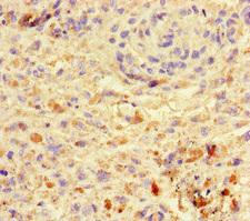 VGLL4 Antibody - Immunohistochemistry of paraffin-embedded human melanoma cancer at dilution of 1:100