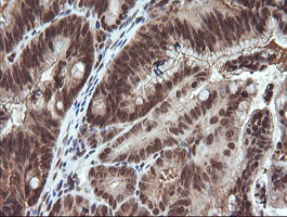 VHL / Von Hippel Lindau Antibody - IHC of paraffin-embedded Adenocarcinoma of Human colon tissue using anti-VHL mouse monoclonal antibody.