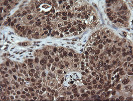 VHL / Von Hippel Lindau Antibody - IHC of paraffin-embedded Carcinoma of Human lung tissue using anti-VHL mouse monoclonal antibody.