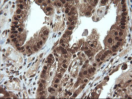 VHL / Von Hippel Lindau Antibody - IHC of paraffin-embedded Adenocarcinoma of Human ovary tissue using anti-VHL mouse monoclonal antibody.