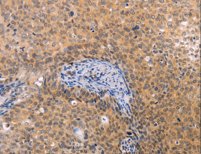 VHL / Von Hippel Lindau Antibody - Immunohistochemistry of paraffin-embedded Human thyroid cancer using VHL Polyclonal Antibody at dilution of 1:40.