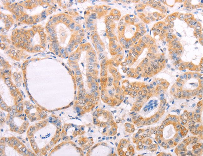 VHL / Von Hippel Lindau Antibody - Immunohistochemistry of paraffin-embedded Human thyroid cancer using VHL Polyclonal Antibody at dilution of 1:40.