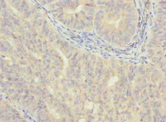 VHLL Antibody - Immunohistochemistry of paraffin-embedded human endometrial cancer using VHLL Antibody at dilution of 1:100