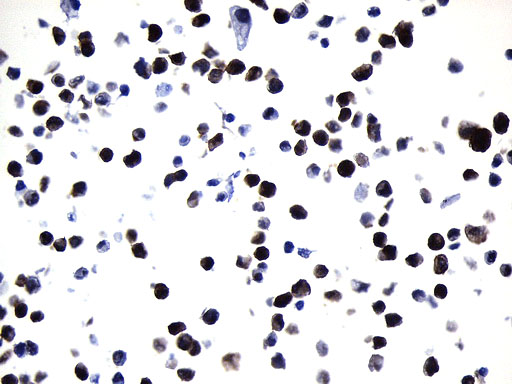 VIL1 / Villin Antibody - Immunohistochemical staining of paraffin-embedded Raji cell pellets using anti-VIL1. (Villin) mouse monoclonal antibody. (Heat-induced epitope retrieval by 1mM EDTA in 10mM Tris buffer. (pH8.0) at 120°C for 2.5 min. (1:1000)