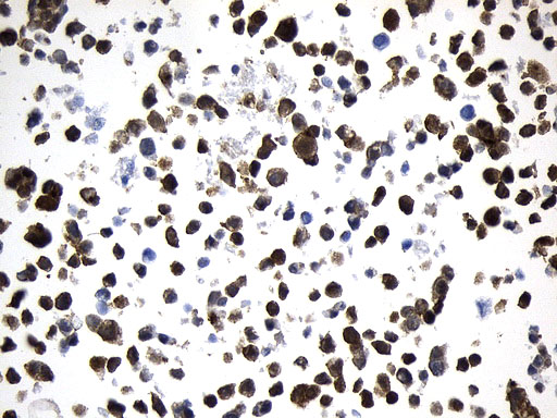 VIL1 / Villin Antibody - Immunohistochemical staining of paraffin-embedded Huh7 cell pellets using anti-VIL1. (Villin) mouse monoclonal antibody. (Heat-induced epitope retrieval by 1mM EDTA in 10mM Tris buffer. (pH8.0) at 120°C for 2.5 min. (1:1000)