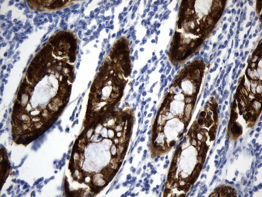 VIL1 / Villin Antibody - Immunohistochemical staining of paraffin-embedded Adenocarcinoma of Human colon tissue using anti-VIL1. (Villin) mouse monoclonal antibody. (Heat-induced epitope retrieval by 1mM EDTA in 10mM Tris buffer. (pH8.5) at 120°C for 3 min. (1:1000)